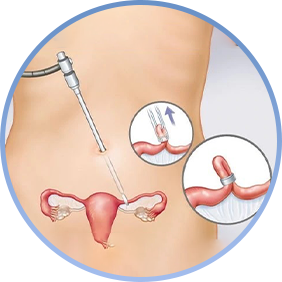 Cervical Cancer Screening